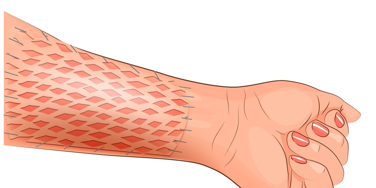 Skin Graft Market Players Will Benefit from Innovations and Technical Advances