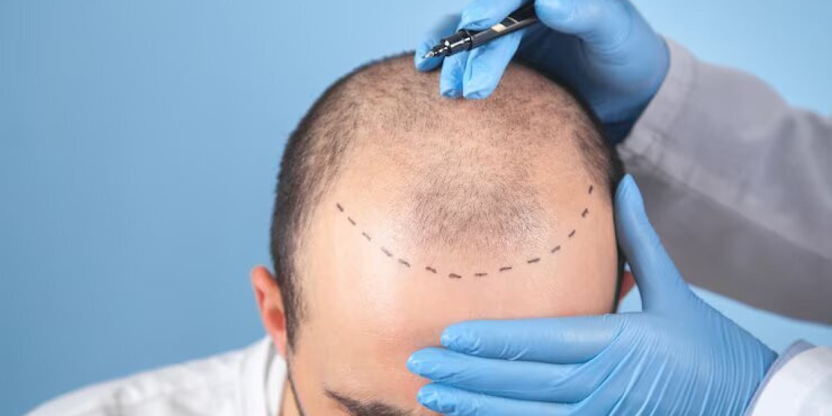 The Benefits of FUE Follicular Unit Extraction