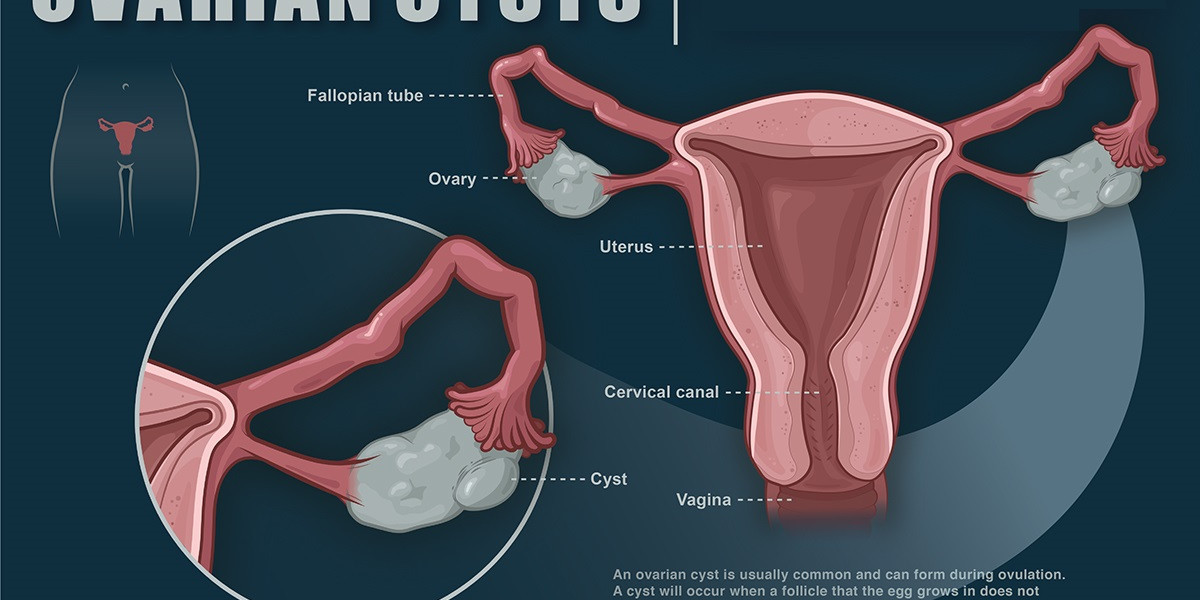 Global Ovarian Cysts Market Players with Regional Segmentations