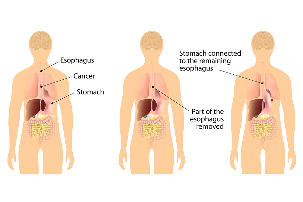 Oesophageal/Oesophagus Cancer Treatment [2024] | Nexus Surgical