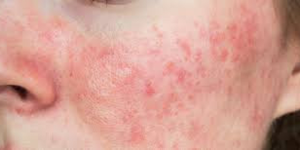 Rosacea Treatment Market Global Impact of COVID-19 on Industry, Share, Growth, Trends, Analysis by Top Key Player and Fo
