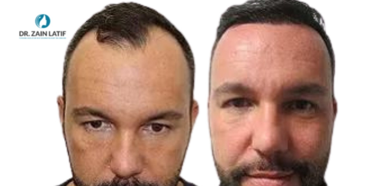 5000 to 10000 Grafts Hair Transplant Cost in Pakistan