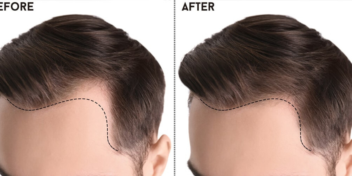 Unveiling the Pinnacle of Hair Transplantation: A Comprehensive Guide to Hair Transplant in Pakistan