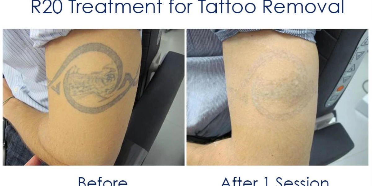 Tattoo Removal Lasers Market Size, Growth Factors & Forecast Report