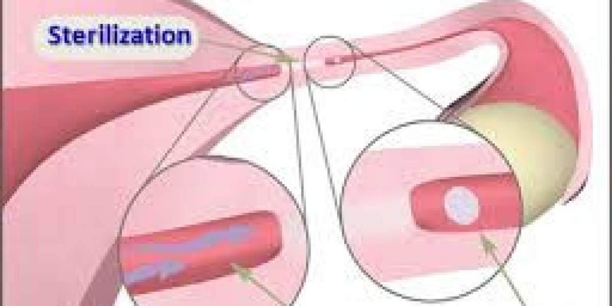 Global Female Sterilization Procedures Market Report - Impact Of Covid-19 And Benchmarking