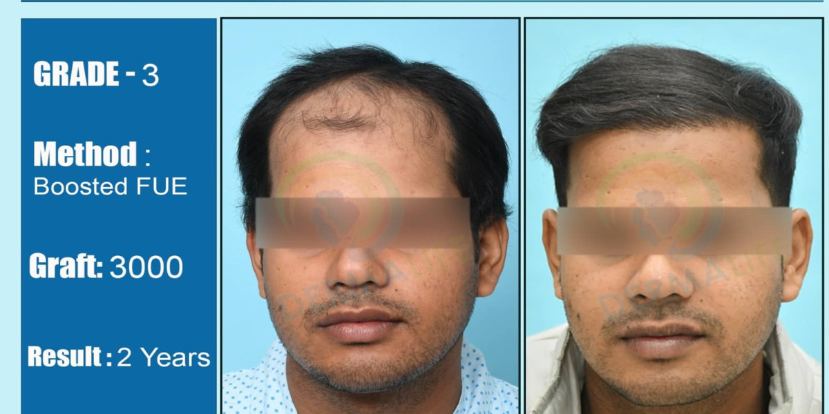 Hair Transplant in Delhi: Step-by-Step Guide from Procedure Insights to the Best Surgeon's Recommendation
