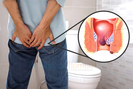 Best & Effective Homeopathic Medicine for Piles and Constipation