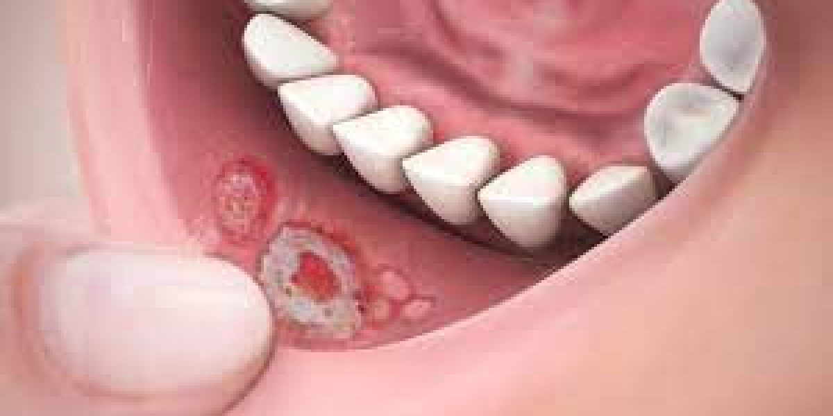 Stomatitis Market : Industry Outlook, Regional Analysis and Forecast