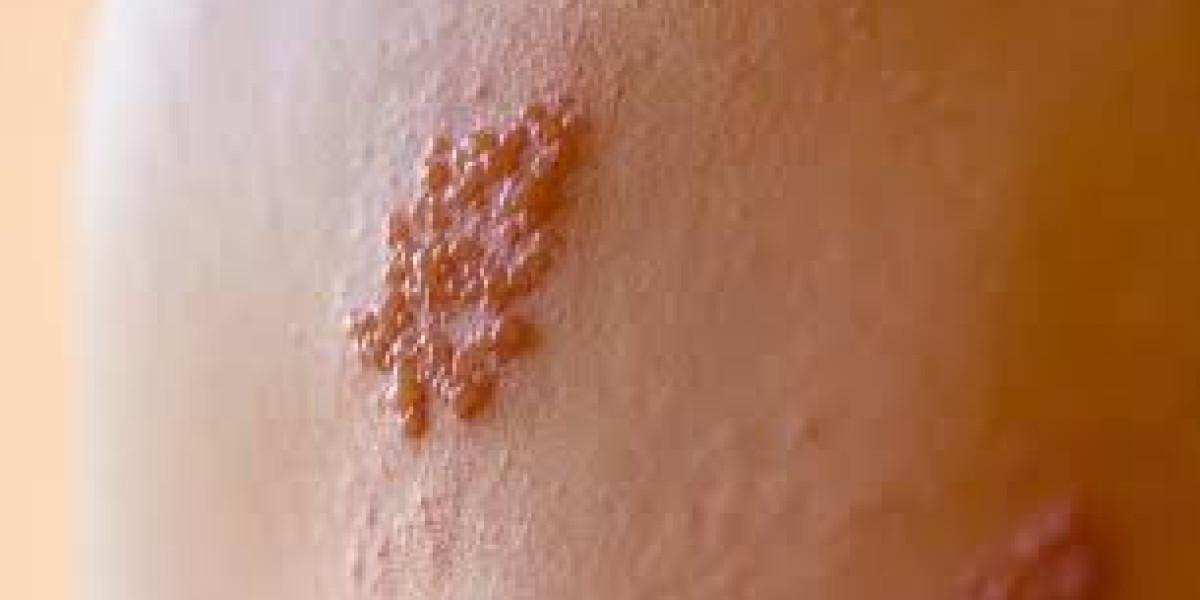 Global Herpes Infection Treatment Market 2023 - Top Key Players Analysis Report Till 2032
