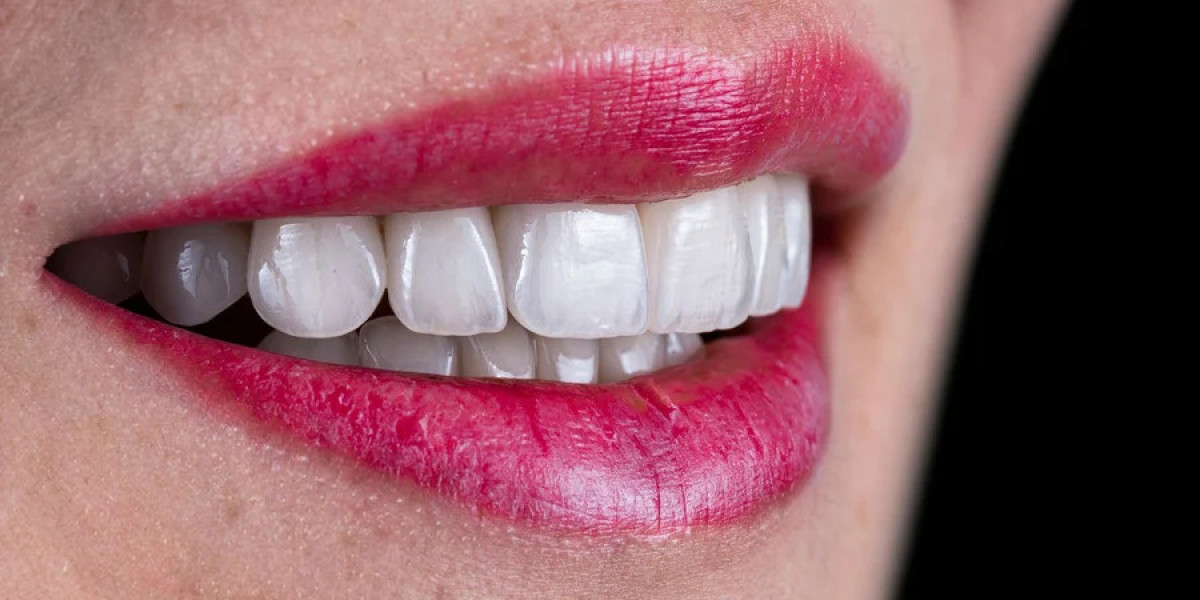 Porcelain Veneers and Teeth Whitening: Elevate Your Holiday Smile