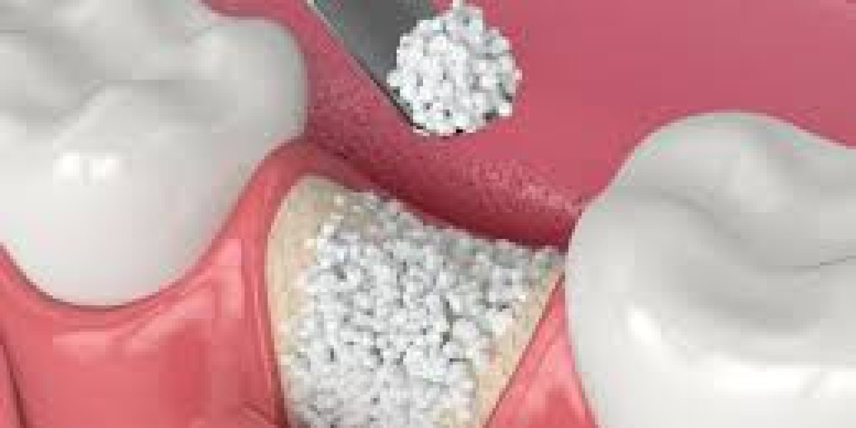Strategic Analysis of the Dental Bone Graft Substitute Market: Size and Trend Insights
