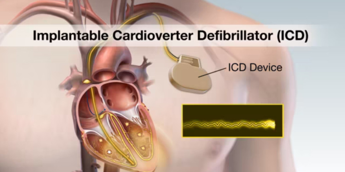 Implantable Cardioverter Defibrillator Market Size, Status, Growth | Industry Analysis Report 2023-2032