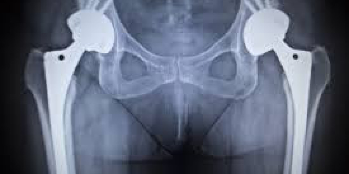 Endoprosthesis Market Competitive Landscape and its Industry Growth Prospect By 2032