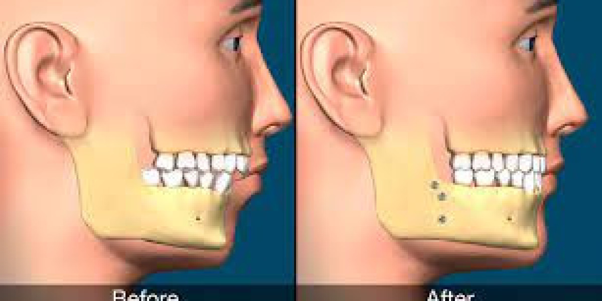 Jaw Surgery Market | Top Key Players Analysis Report