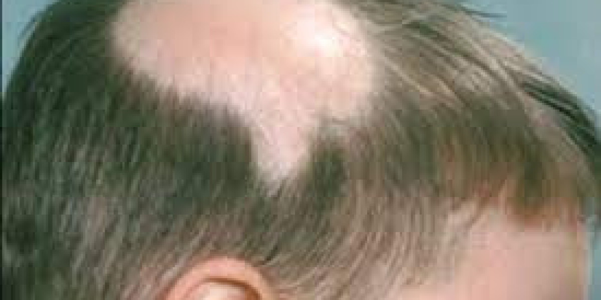 Alopecia Treatment Market Size & Forecast Research Report to 2032