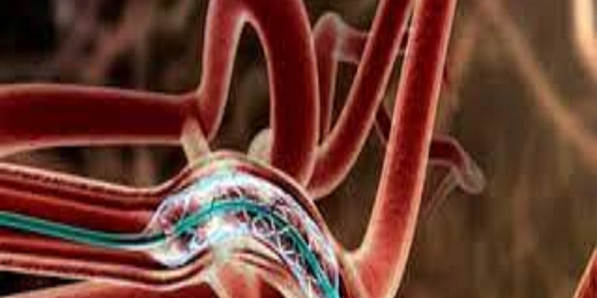 Intracranial Stents Market Report 2023 with Analysis of COVID-19 Impact