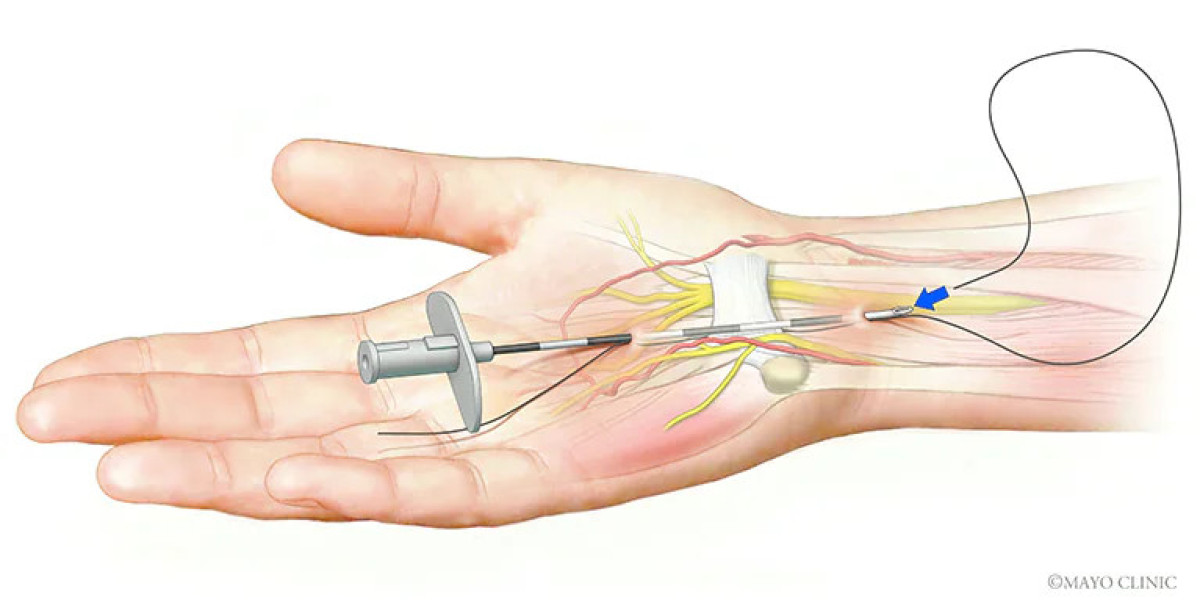 Carpal Tunnel Release Systems Market | Global Industry Growth, Trends, and Forecast 2023 - 2032