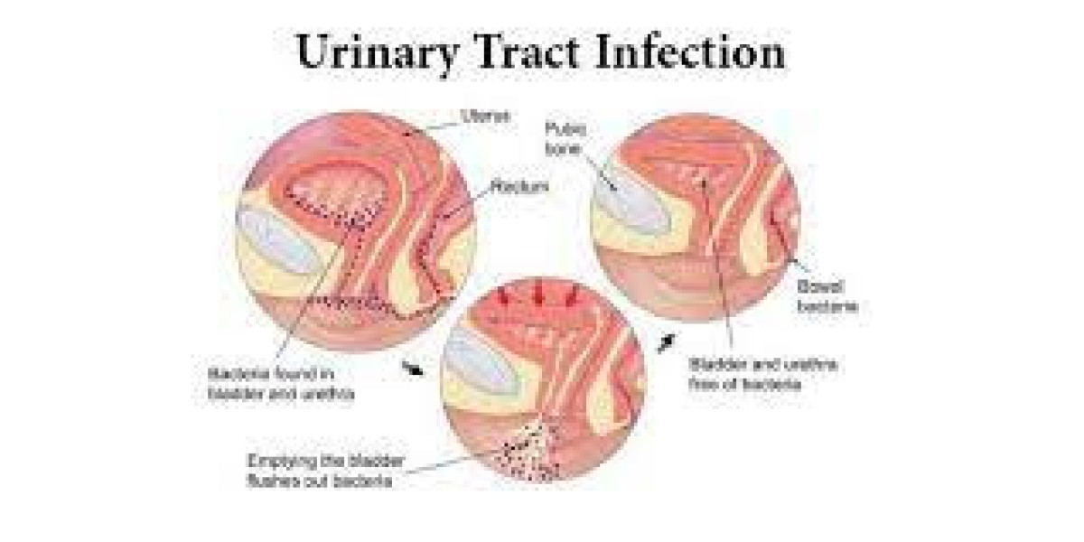 Urinary Tract Infection Treatment Market Report, Latest Trends, Industry Opportunity Report to 2032