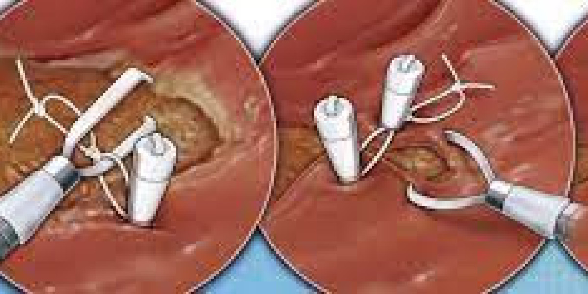 Endoscopic Clip Market Research Report: Global Industry Overview to 2032