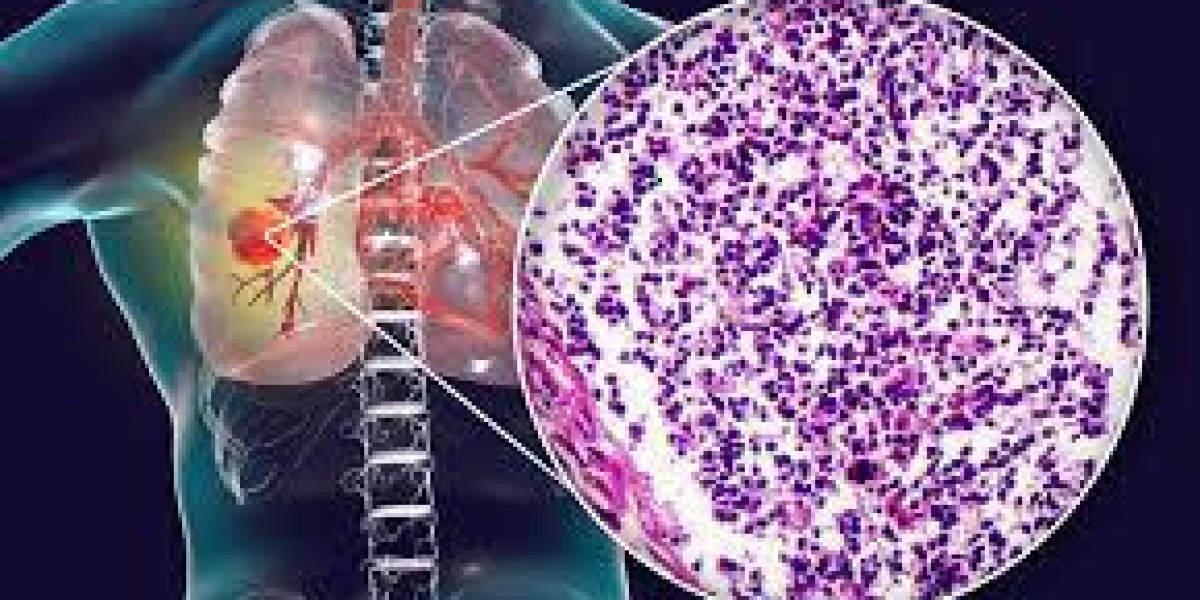 Global Small Cell Lung Cancer (SCLC) Therapeutics Market 2023: COVID-19 Impact Analysis and Industry Forecast Report, 20
