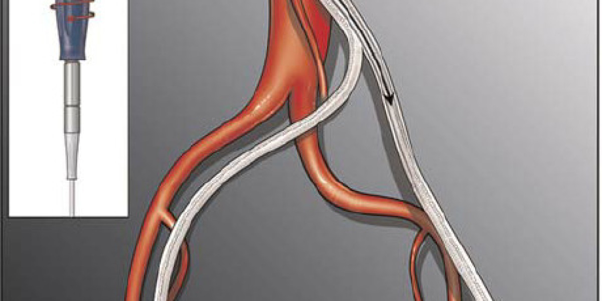 Aortic Stents Grafts Market Size, Industry Research Report 2023-2032