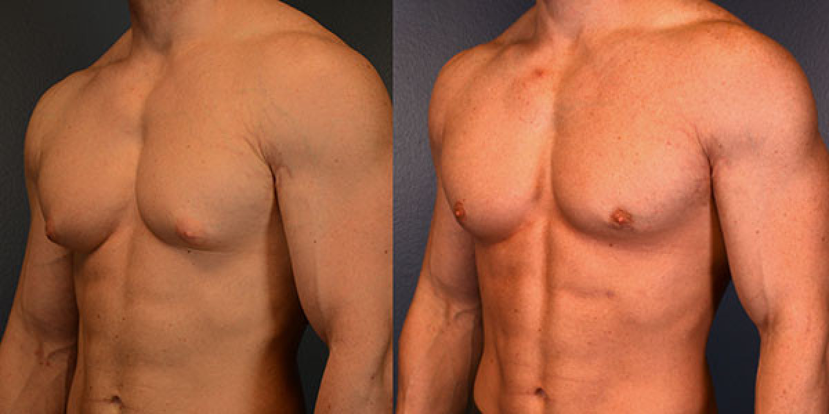 Importance of Nutrition in Optimizing Gynecomastia Surgery Results