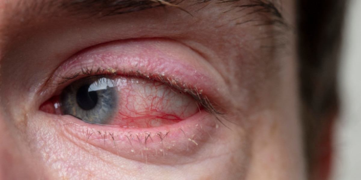 Allergic Conjunctivitis Market will be US$ 2.40 Billion by 2032