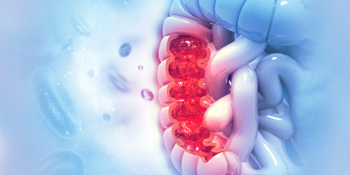 Colorectal Cancer Therapeutic  Market 2023 Global Industry Analysis With Forecast To 2032