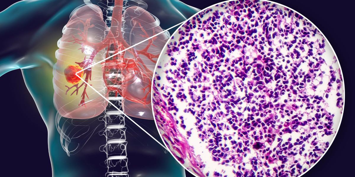 Small Cell Lung Cancer (SCLC) Treatment Market Share, Trends and Forecast by 2030