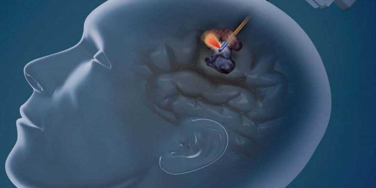 MRI Guided Neurosurgical Ablation Market 2023 Global Industry Analysis With Forecast To 2032