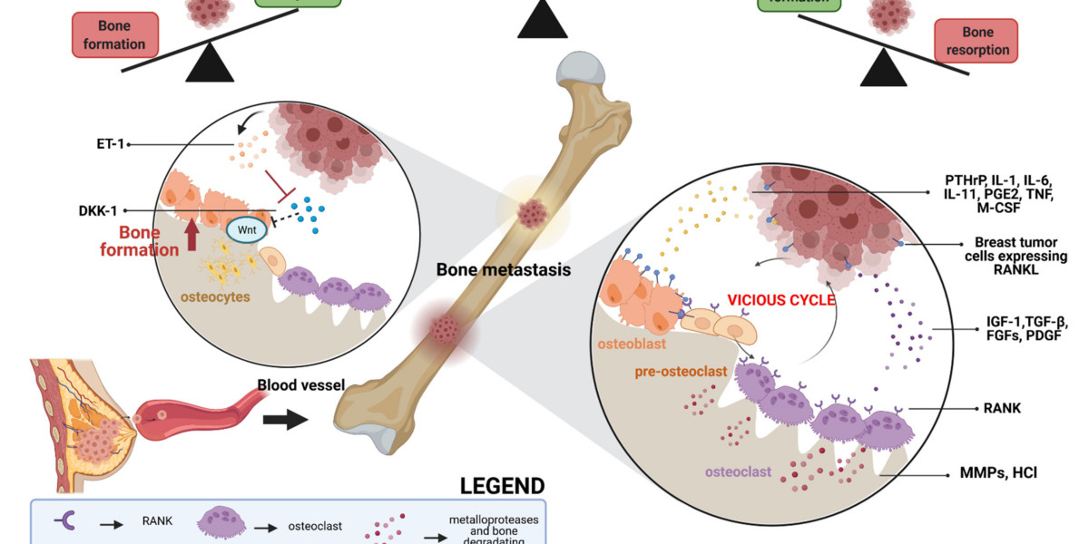 Bone Metastasis Market Size, Share, Trends, and Forecast by 2031