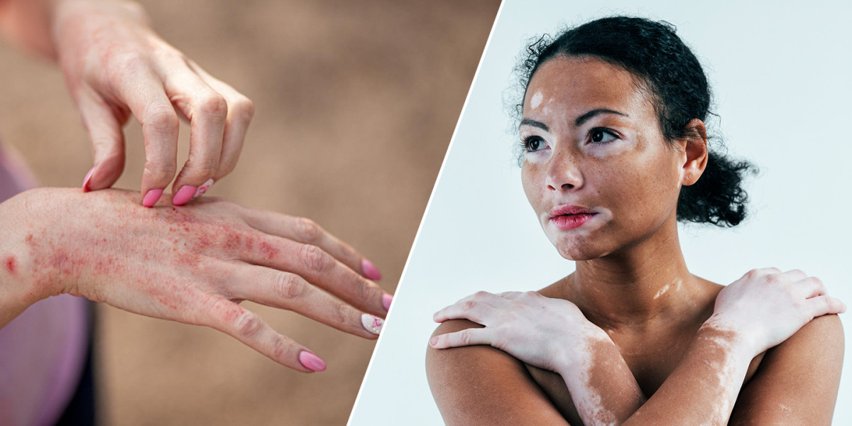 Pityriasis Alba vs. Vitiligo: Understanding the Differences and Treatment Options