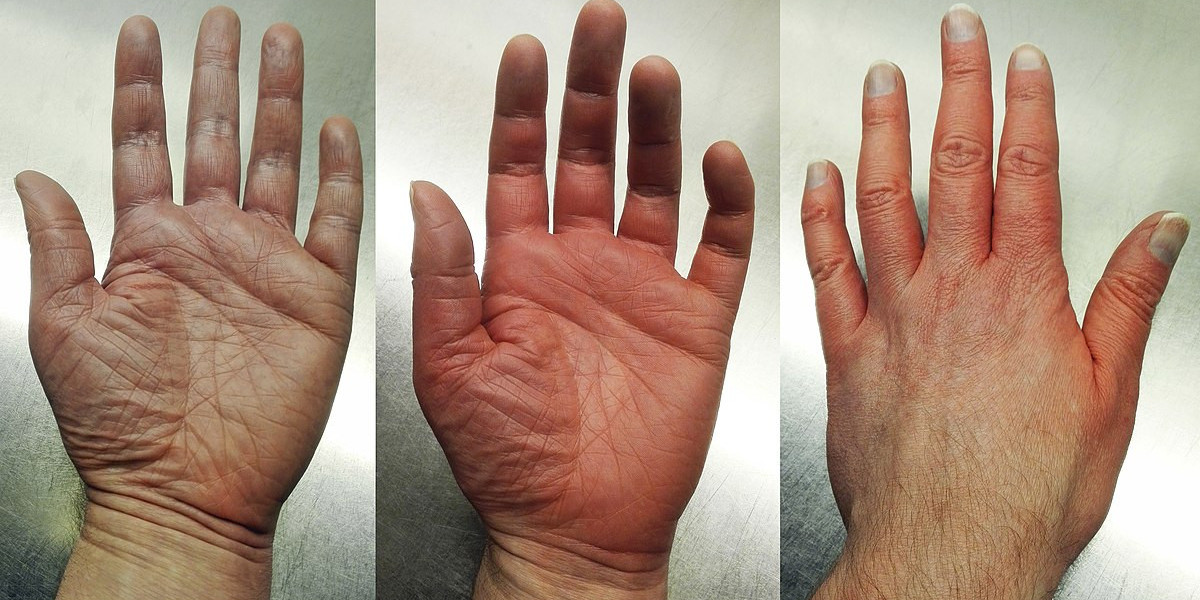 Erythromelalgia Treatment Market Size, Growth & Industry Research Report, 2032