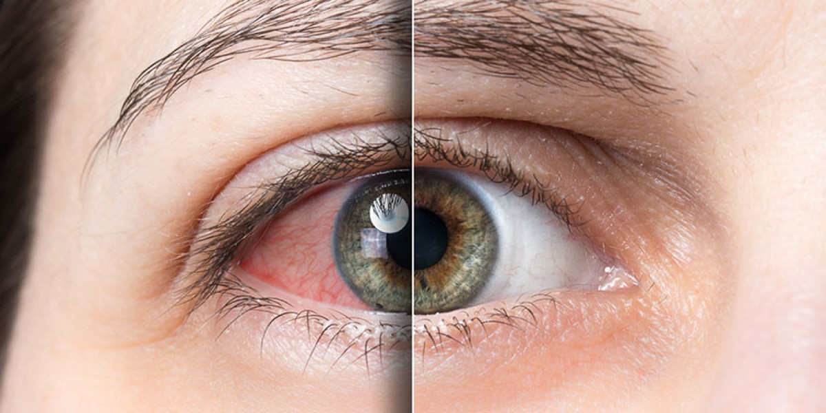 Dry Eye Syndrome Market Outlook (2024-2031)
