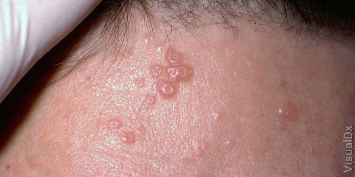 Molluscum Contagiosum Market Size, Growth & Industry Research Report, 2032
