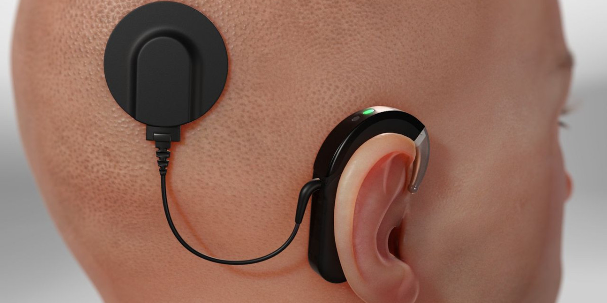 Hearing Implant Market Size, Outlook Research Report 2023-2032