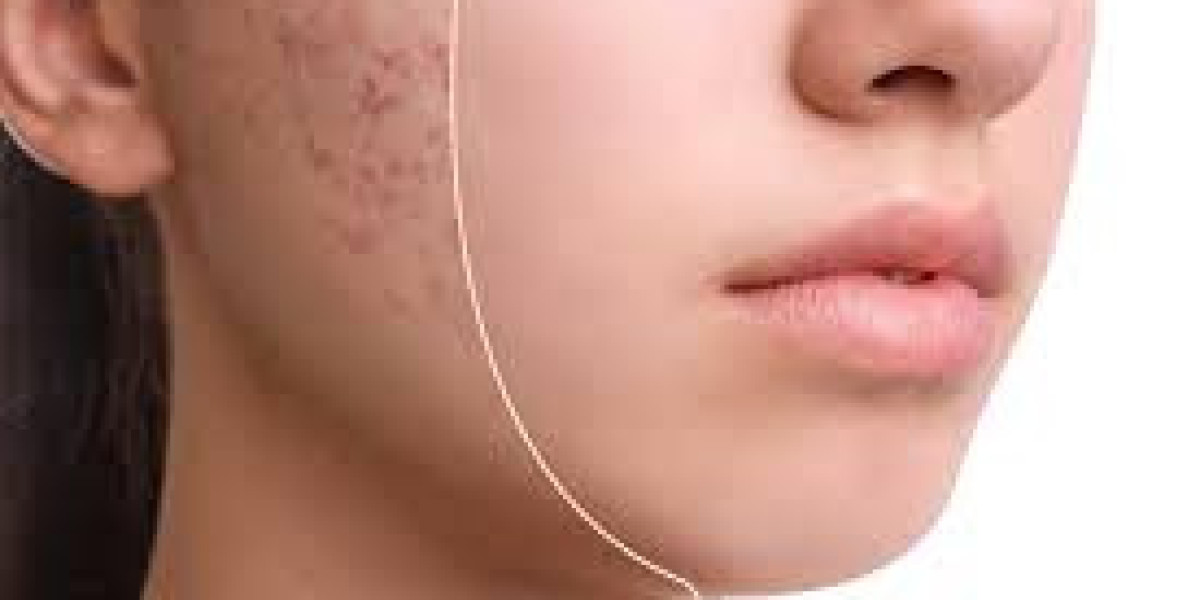 Glycolic Acid Market Report, Latest Trends, Industry Opportunity & Forecast to 2032