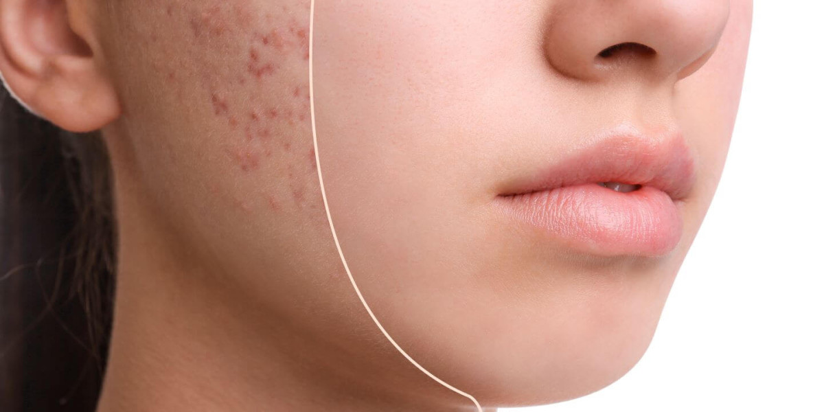 Acne Drugs Market Outlook (2024-2031)