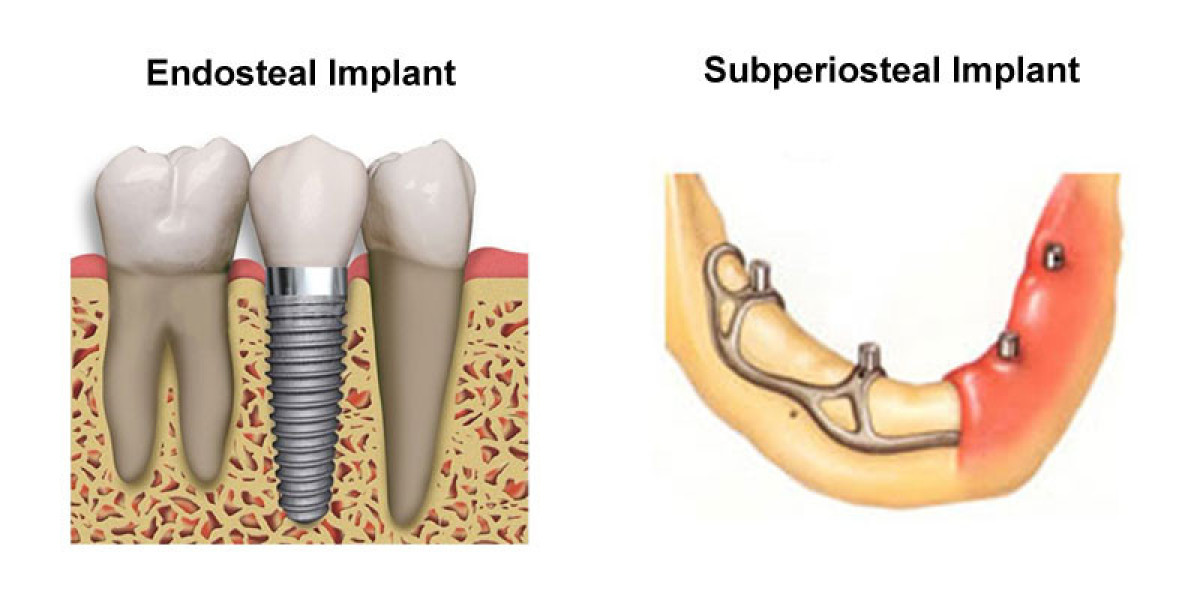 Endosteal Implant Market Regional Share, Trends, and Forecast by 2031