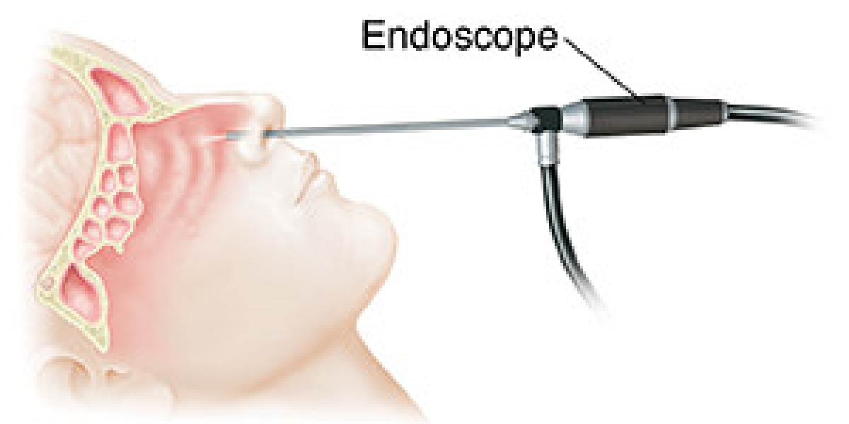 Global Nasal Endoscopy Market 2023 - Top Key Players Analysis Report Till 2032