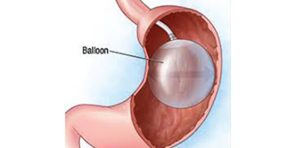 Intragastric Balloon Market 2023 Global Industry Analysis With Forecast To 2032