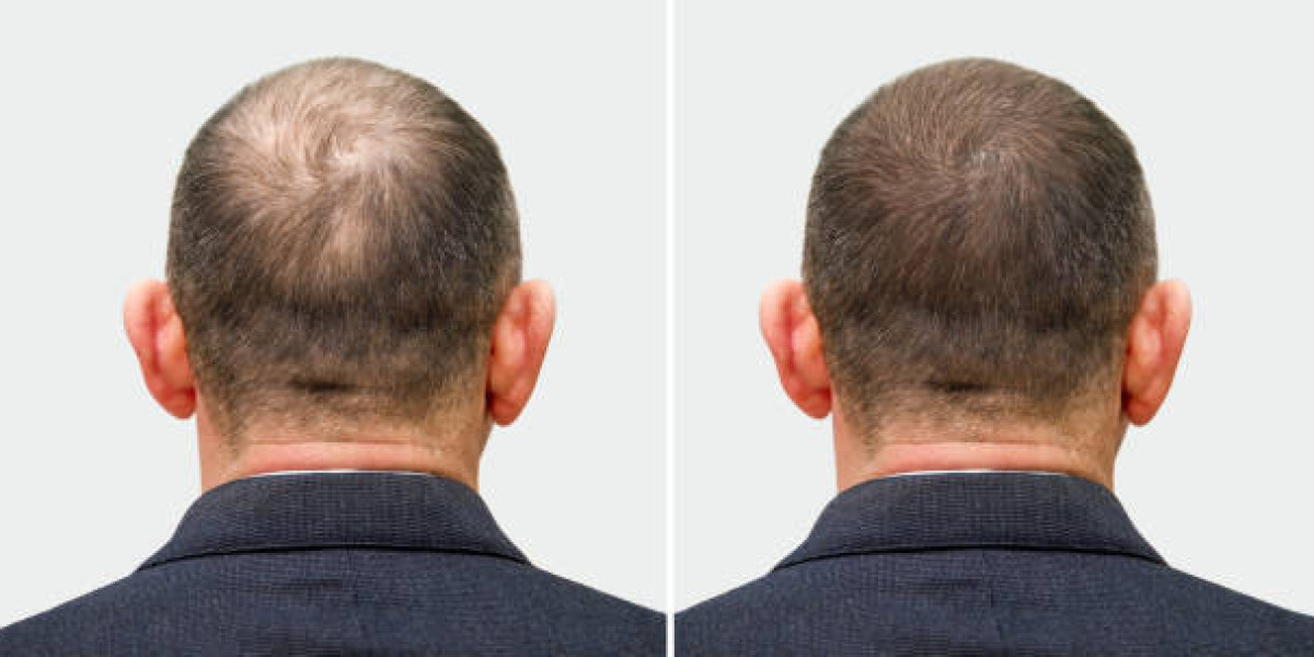 What to expect 12 days following a hair transplant