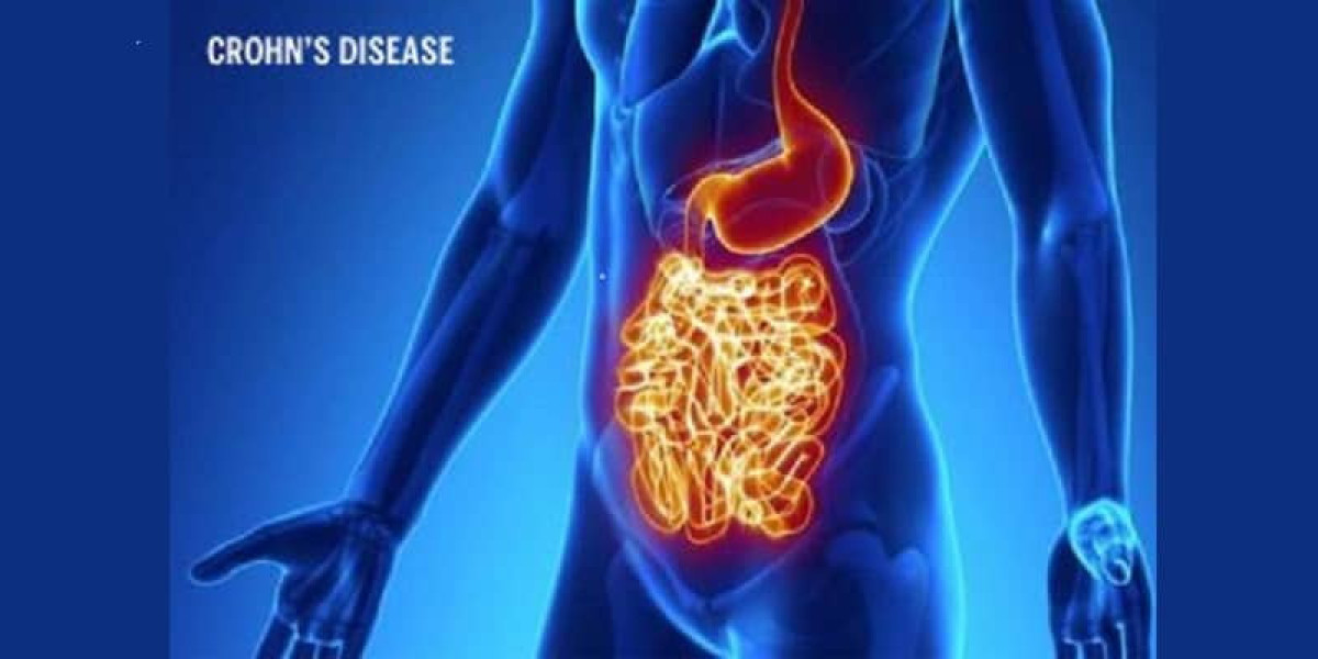 Crohn's Disease Market Trends and Analysis