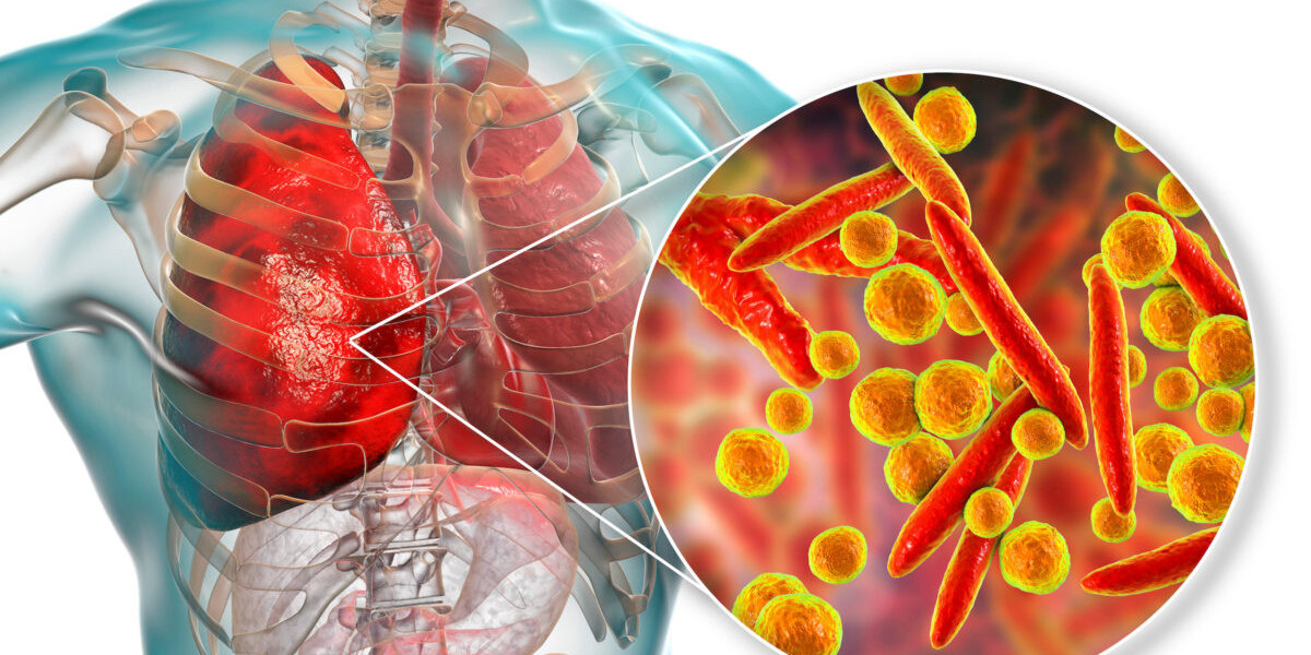 Pneumonia Therapeutics Market Growth Potentials, Trends and Forecast by 2031