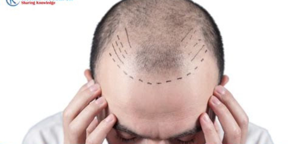 Hair Transplant Market Size And Forecast Report 2023-2028