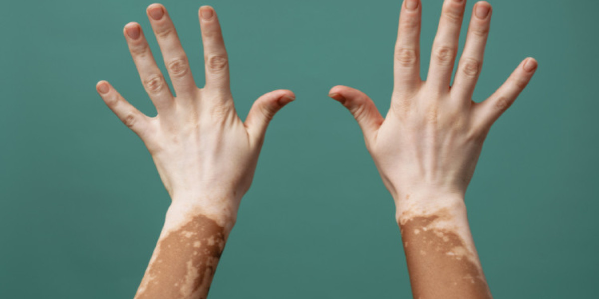 Global Vitiligo Market Size And Forecast 2024-2032