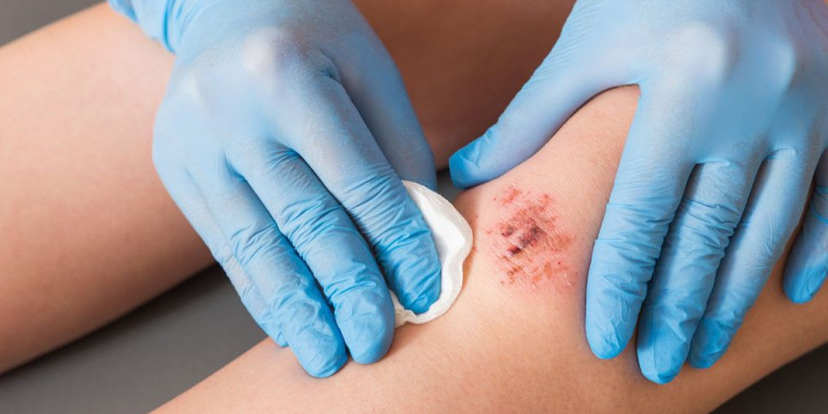 Wound Healing Market | Industry Outlook Research Report 2023-2032 By Value Market Research