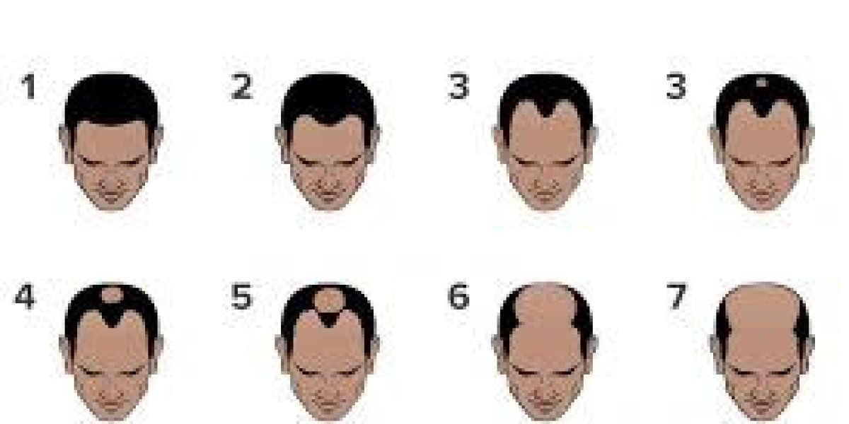 Stage 7 Hair Loss Treatments