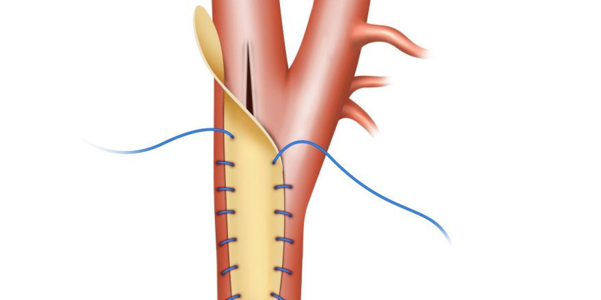 Vascular Patches Market Forecast and Outlook (2024-2031)