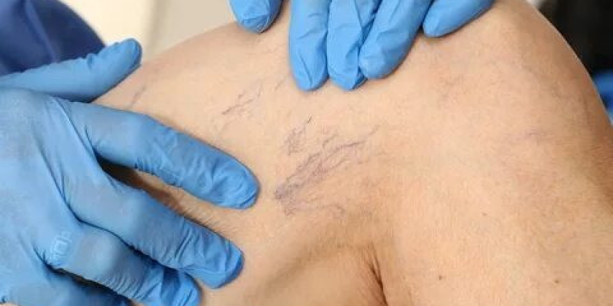 Unsightly Veins Got You Down? Exploring Laser Vein Treatment in Winnipeg